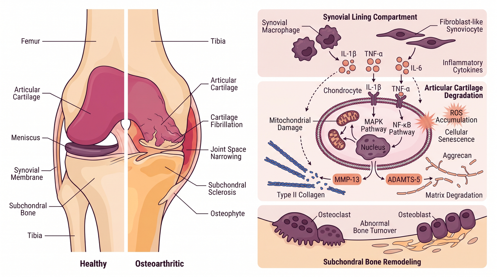 Osteoarthritis pathogenesis figure made with aFig